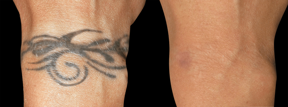 How Long Does Laser Tattoo Removal Take to Heal ...