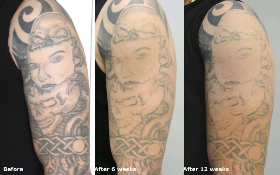 How Long in Between Tattoo Removal Treatments?