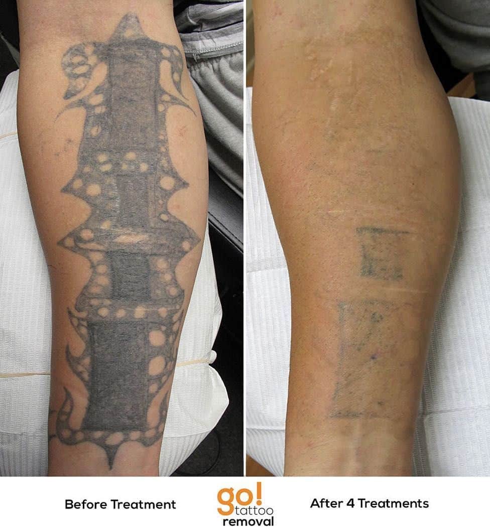 How Long Should You Wait Between Tattoo Removal Sessions