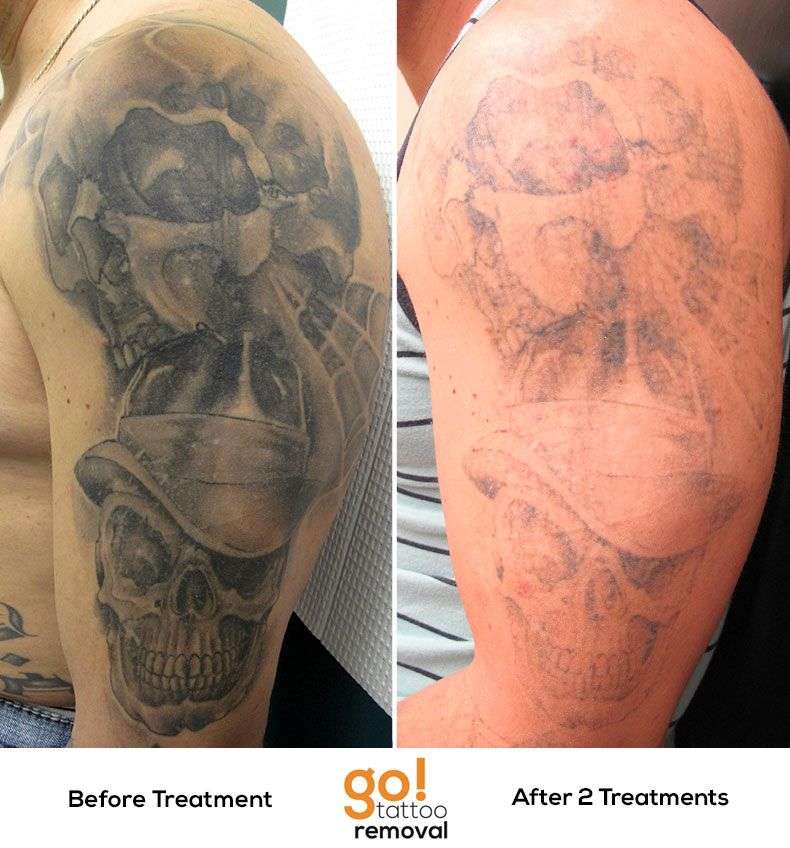 How Long Should You Wait Between Tattoo Removal Sessions ...