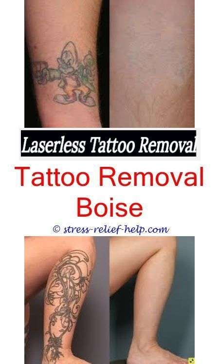 How Many Sessions Needed To Remove Tattoo / Tattoo Removal ...