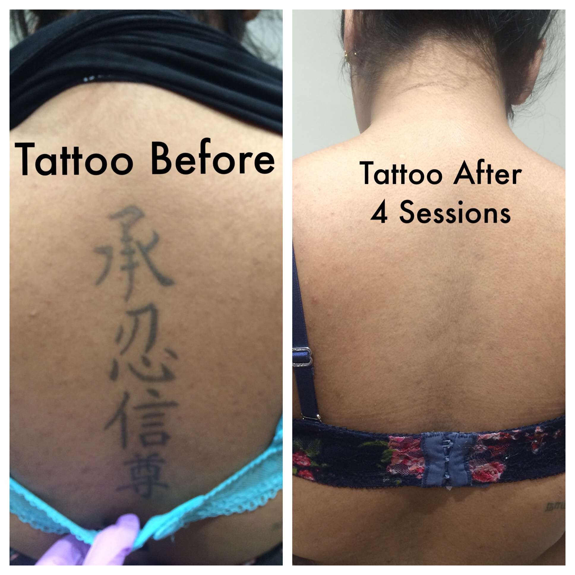 How Many Sessions To Remove Finger Tattoo / Before and ...