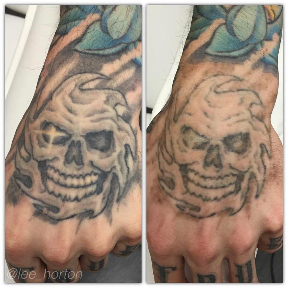 How Many Sessions To Remove Hand Tattoo
