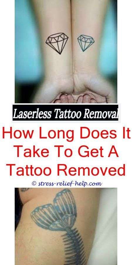 How many treatments needed to remove tattoo.Does laser ...