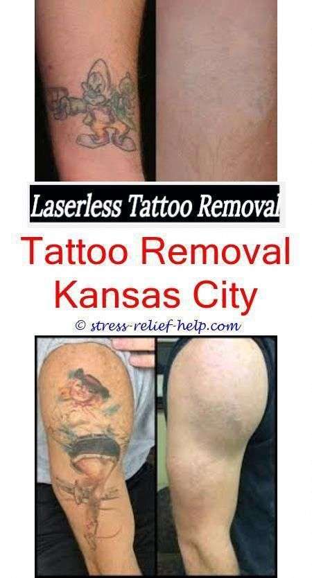 How Much Does A Small Tattoo Removal Cost