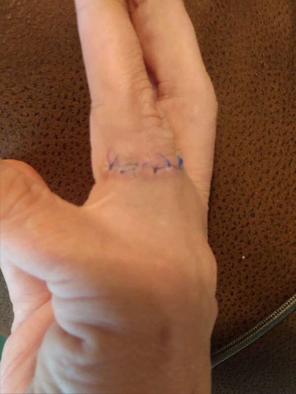 HOW MUCH DOES FINGER TATTOO REMOVAL COST