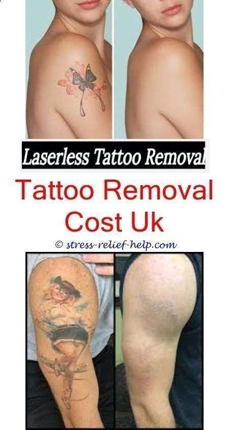 How Much Does It Cost To Have Tattoos Removed