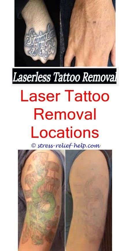 How much does it cost to remove a tattoo.Laser tattoo removal in my ...