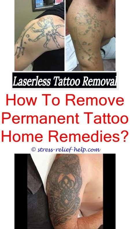 How much does it cost to remove a tattoo.Post tattoo removal.How long ...