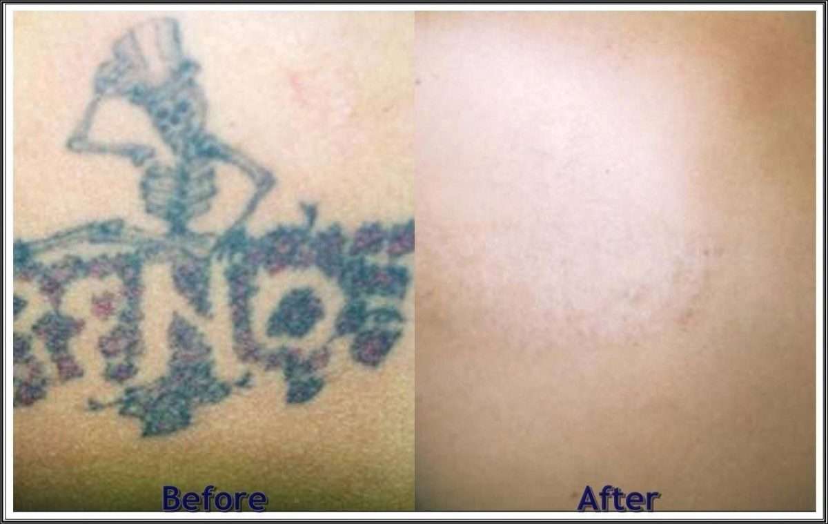 How Much Does It Cost To Start A Tattoo Removal Business