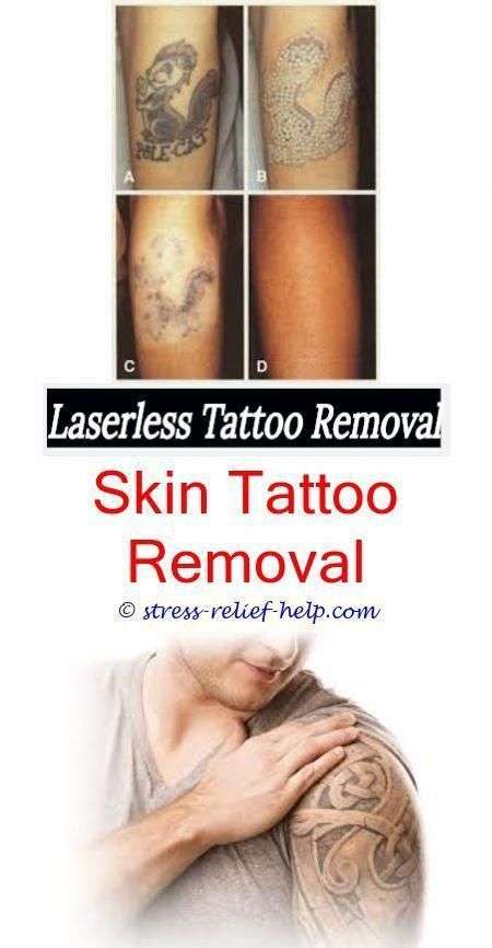 How Much Does Laser Tattoo Removal Cost Uk / How Removal Much Tattoo ...