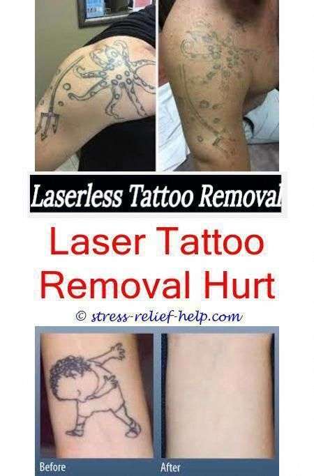 How much does laser tattoo removal cost uk.Laserless tattoo removal ...