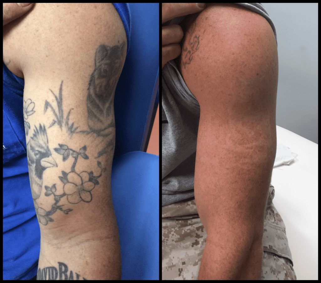 How Much Is Laser Tattoo Removal Cost