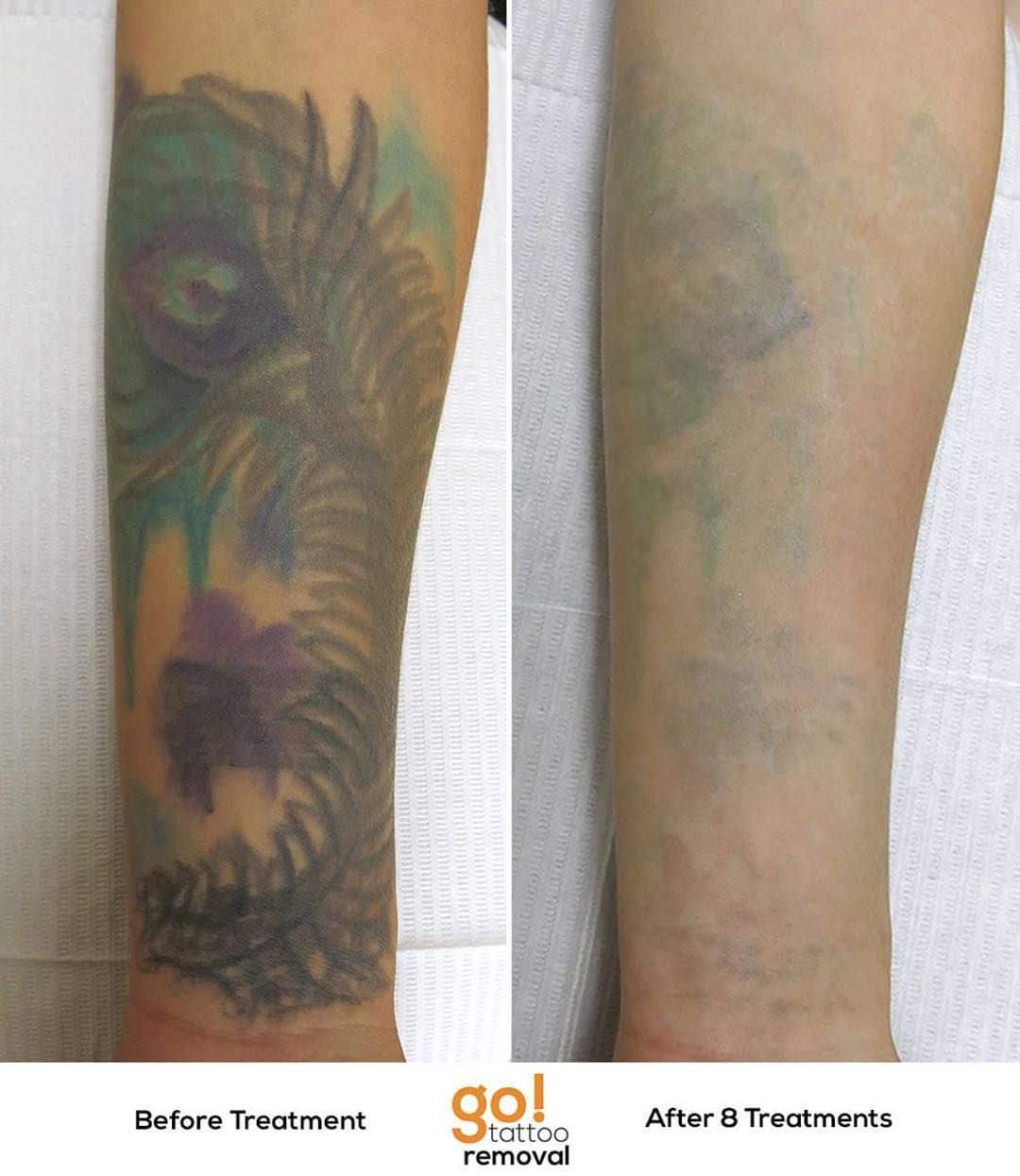 How Much Is Picosure Tattoo Removal
