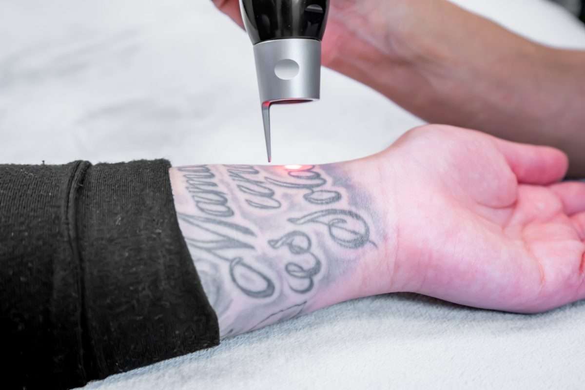How Painful is a Tattoo Removal?