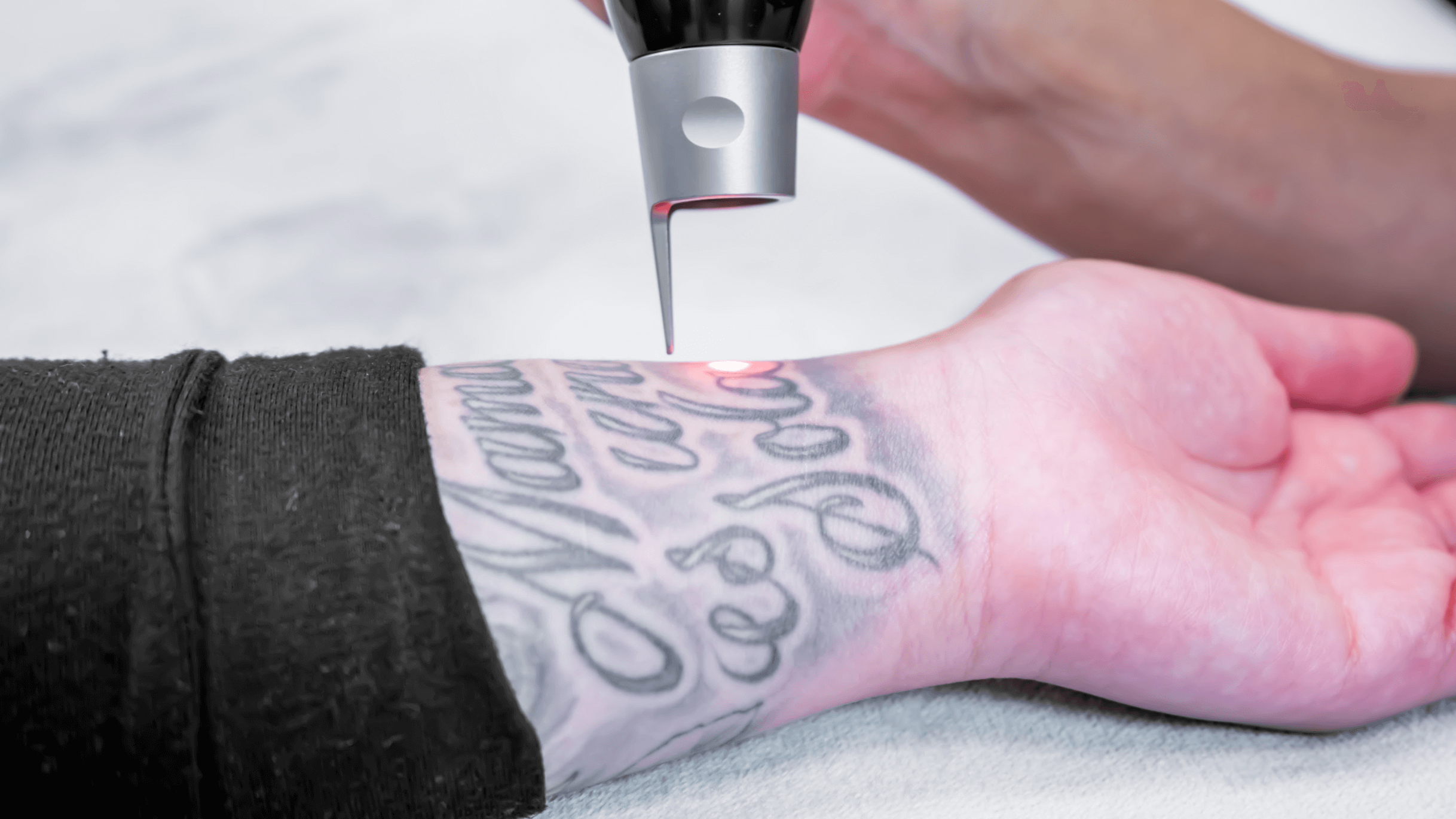 How Soon Can I Have Laser Tattoo Removal After Getting A ...