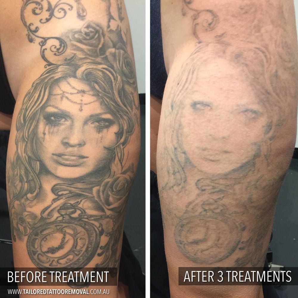 How To Get Insurance To Cover Tattoo Removal