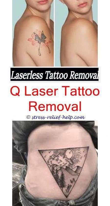 How to remove a permanent tattoo without laser.How is a tattoo removed ...