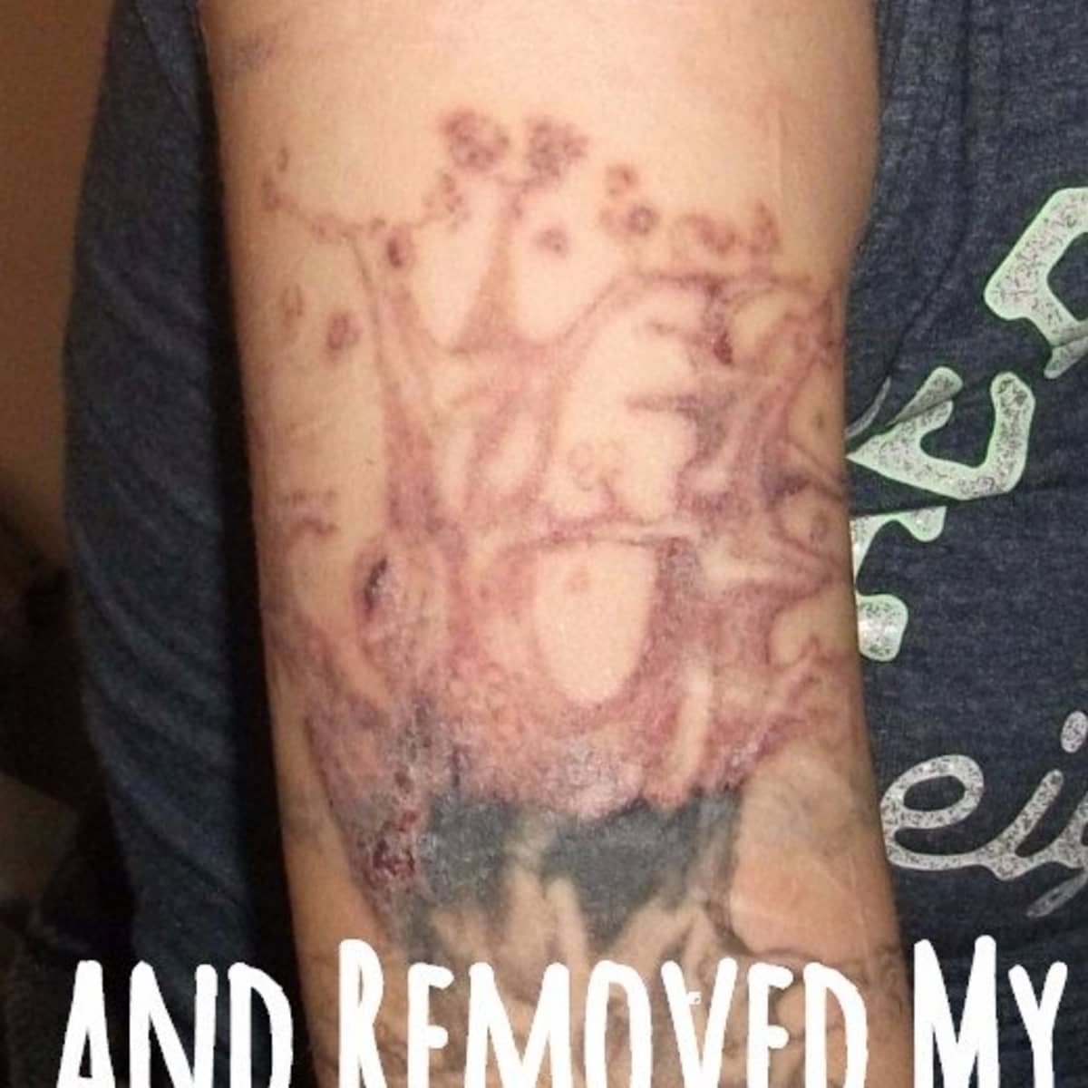 How To Remove A Tattoo At Home Quickly / At Home Tattoo Removal Methods ...
