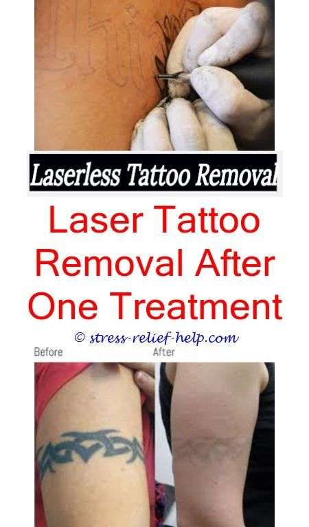 How to remove permanent tattoo in hyderabad.Can you get tattoos removed ...