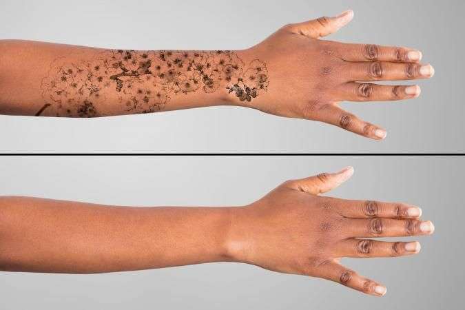 How to Remove Stick and Poke Tattoos