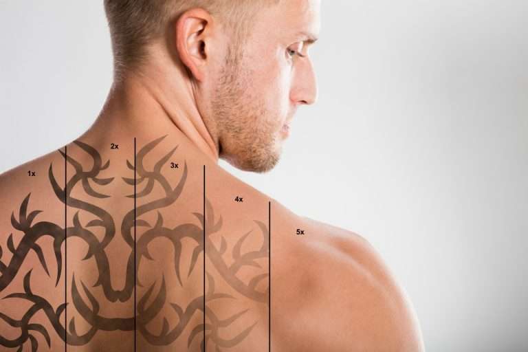 How To Remove Unwanted Tattoos