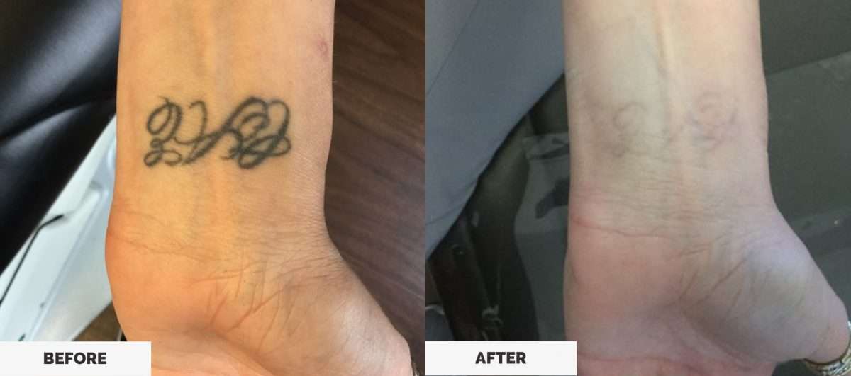 How to safely get a tattoo removed â Buy Now