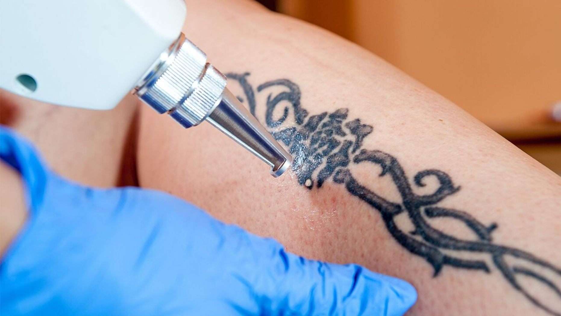 Human Sex Trafficking in Omaha Branding Tattoo Removal