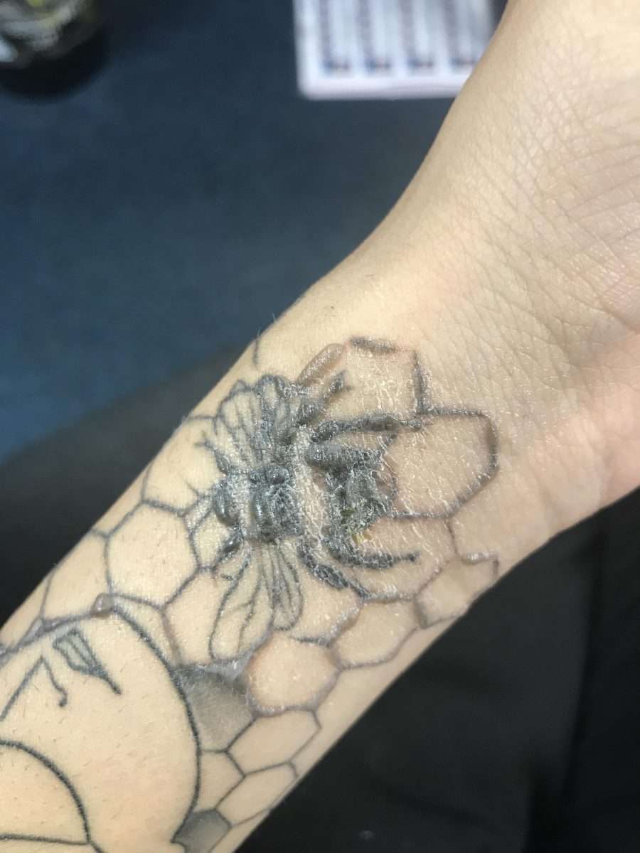 I got my first tattoo removal sesssion yesterday and I accidentally ...