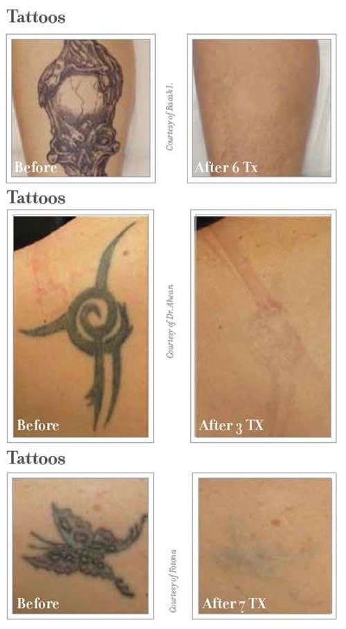 If you are looking for tattoo removal and live in Jacksonville FL, then ...