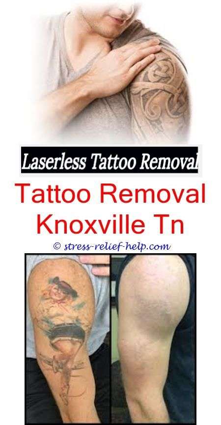 large tattoo removal can tattoos be removed yahoo