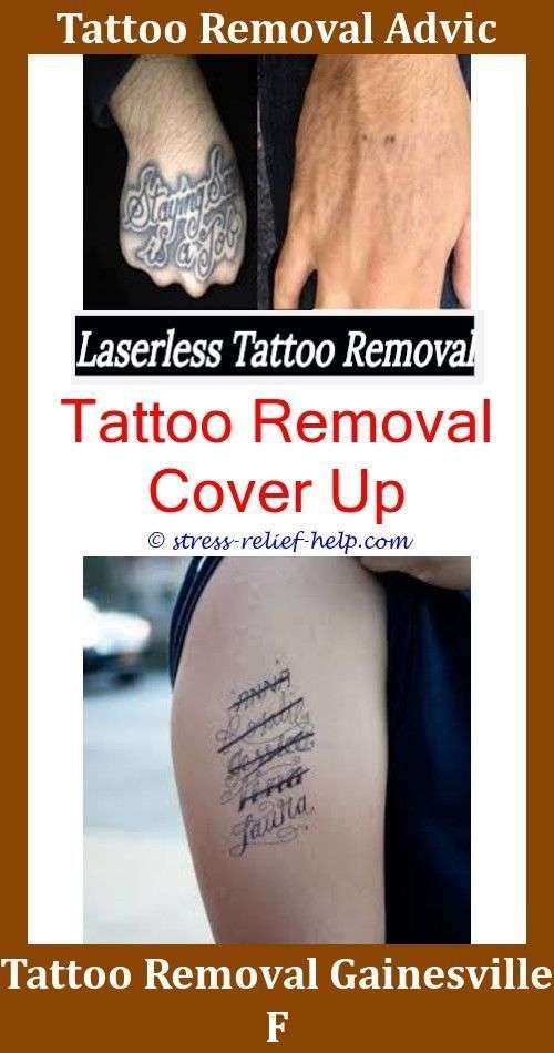 Laser Away Tattoo Removal Prices