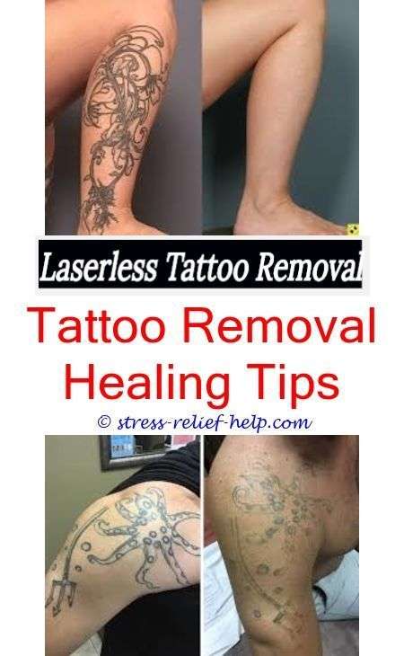 Laser Away Tattoo Removal Results