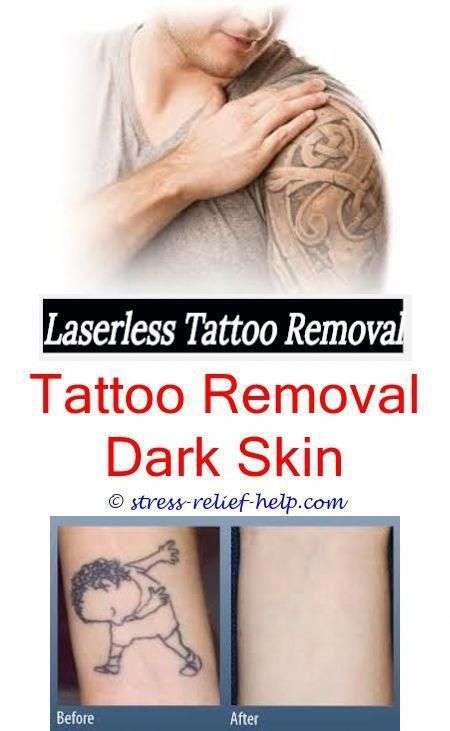 Laser Away Tattoo Removal Reviews