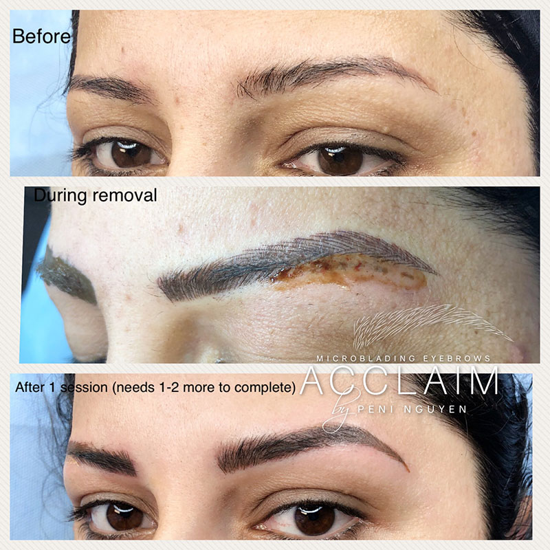 Laser Eyebrow Tattoo Removal Before And After