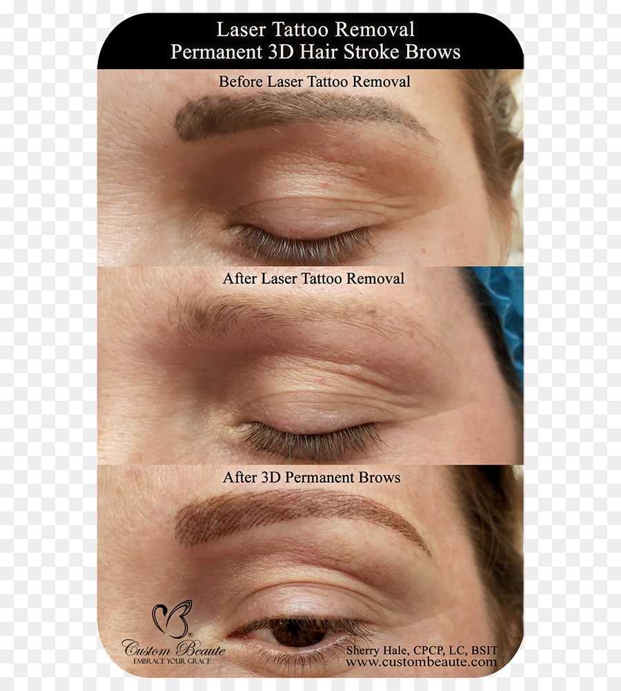Laser Eyebrow Tattoo Removal / Cosmetic And Eyebrow Tattoo Removal ...