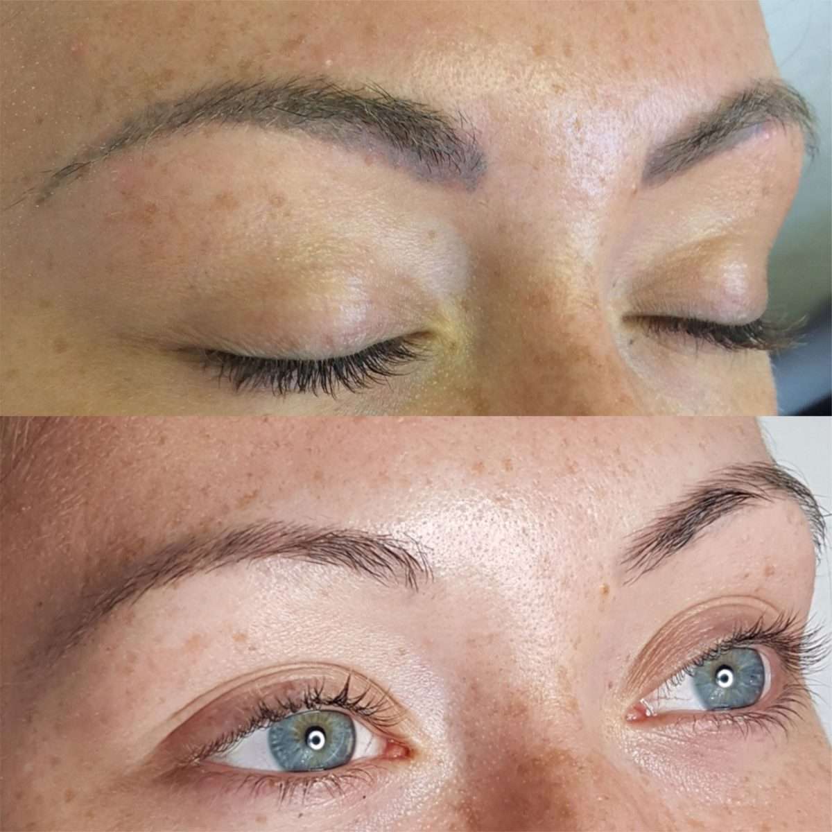 Laser Eyebrow Tattoo Removal Healing Process