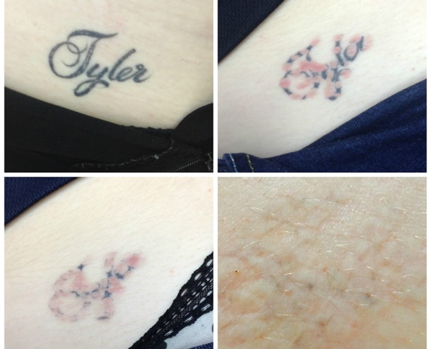 LASER FREE TATTOO REMOVAL
