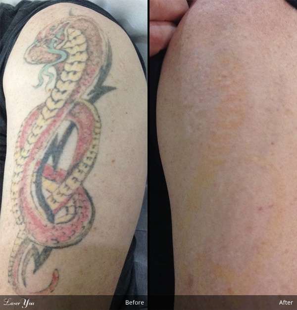 Laser Tattoo Removal Adelaide