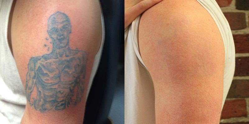 Laser Tattoo Removal After 3 Sessions