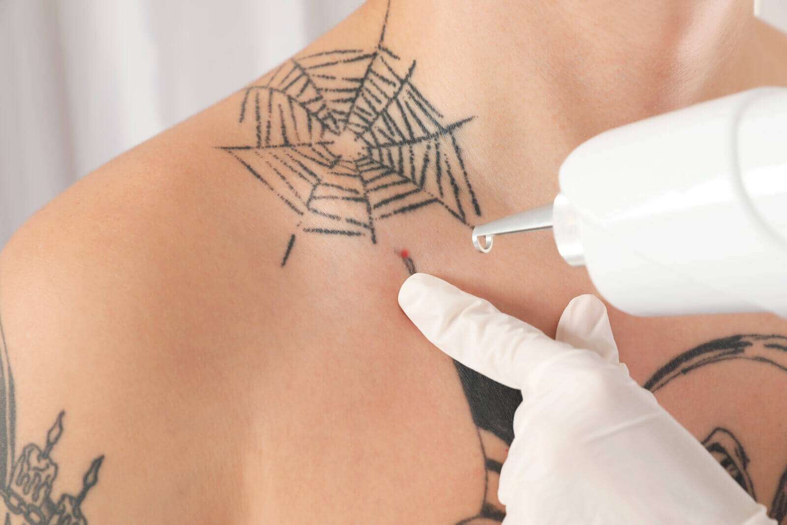 Laser Tattoo Removal Aftercare Tips [How to Heal Faster!]