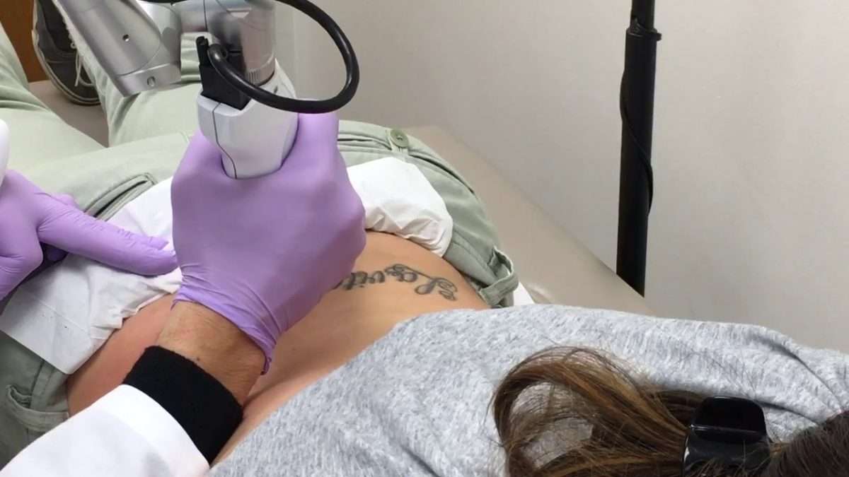 Laser Tattoo Removal at Enlighten Aesthetic of Cleveland