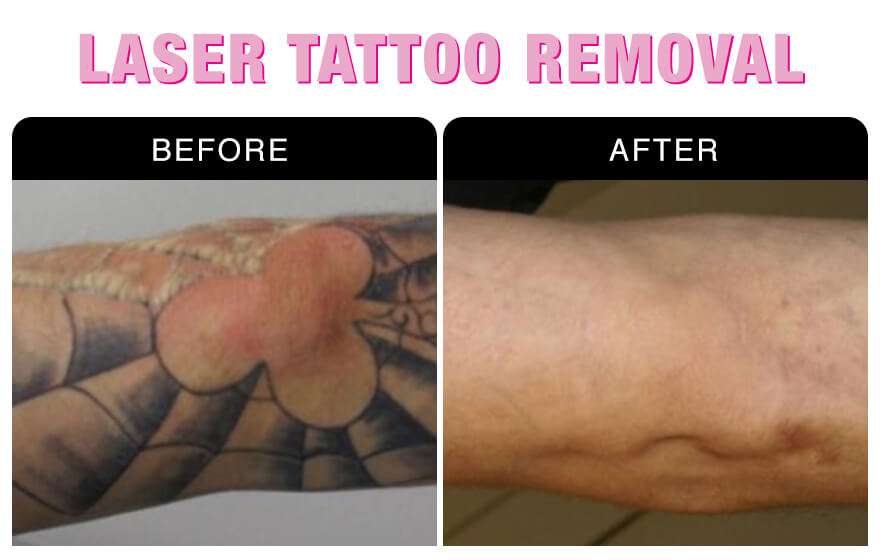 Laser Tattoo Removal at National Laser Institute