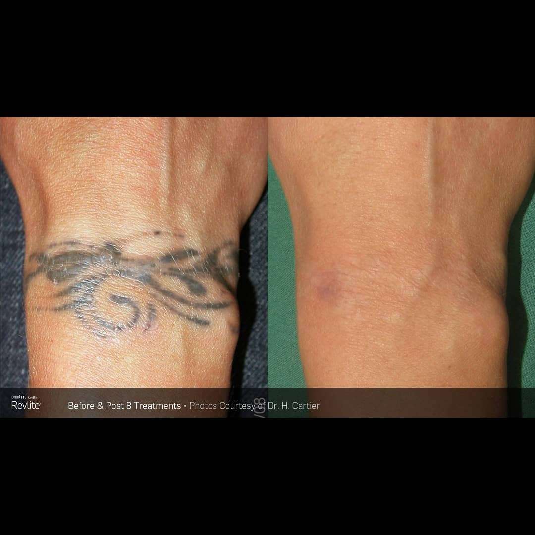 Laser tattoo removal at Revekka Treatments