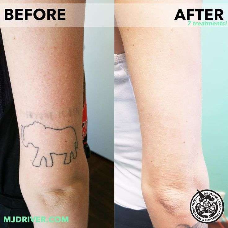 Laser tattoo removal at WA Ink by @mjdriverlasertattooremoval and ...