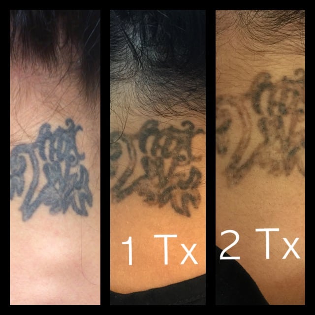 Laser Tattoo Removal Austin Tx : Laser Tattoo Removal Training Tattoo ...