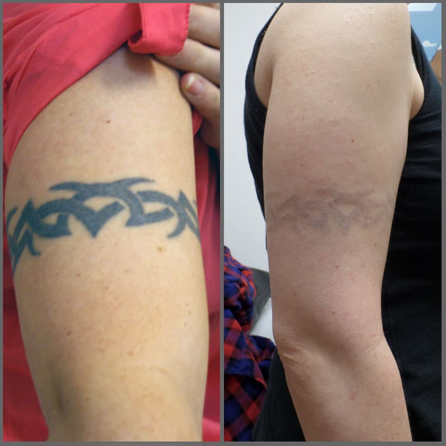 Laser tattoo removal before &  after