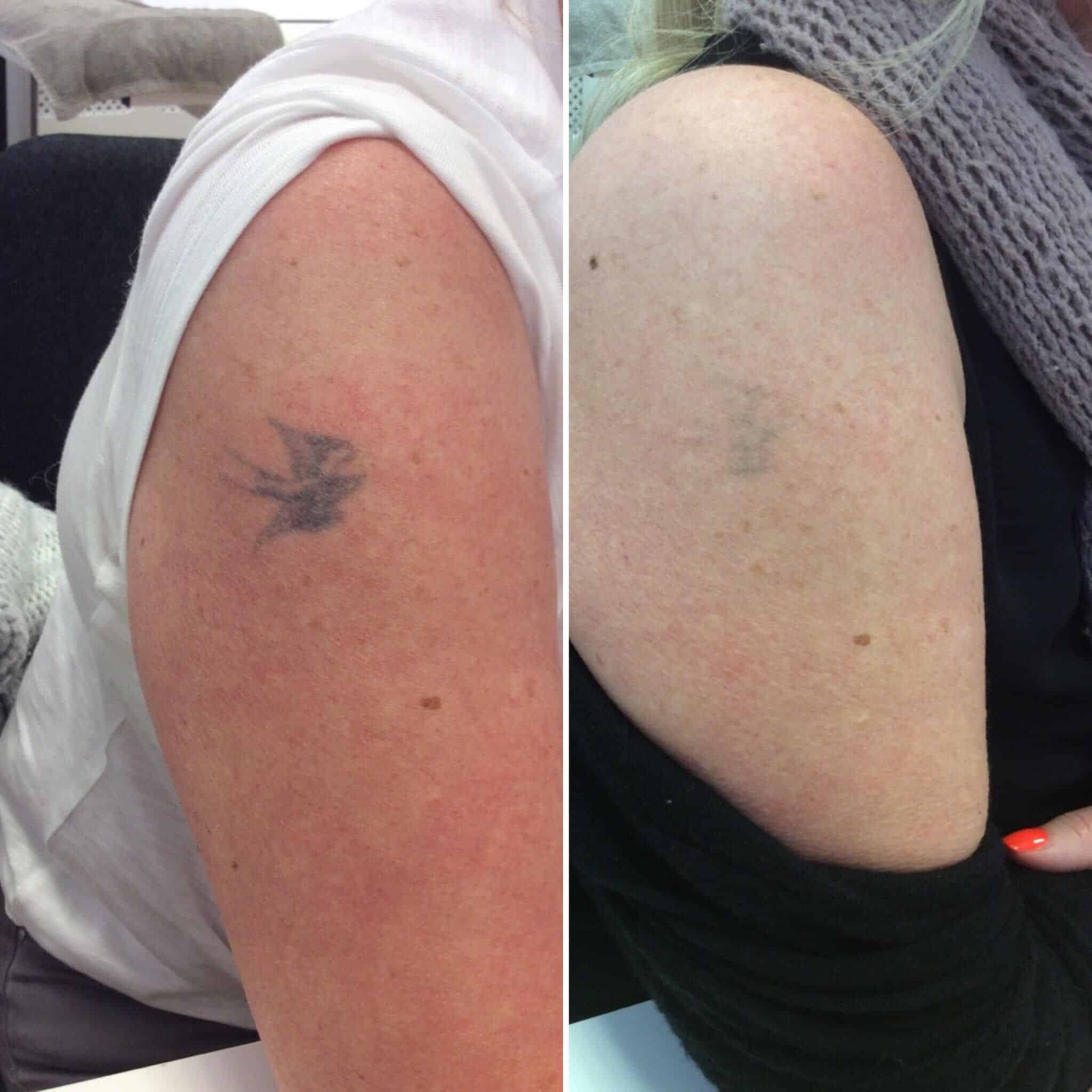 Laser Tattoo Removal Before And After 1 Session