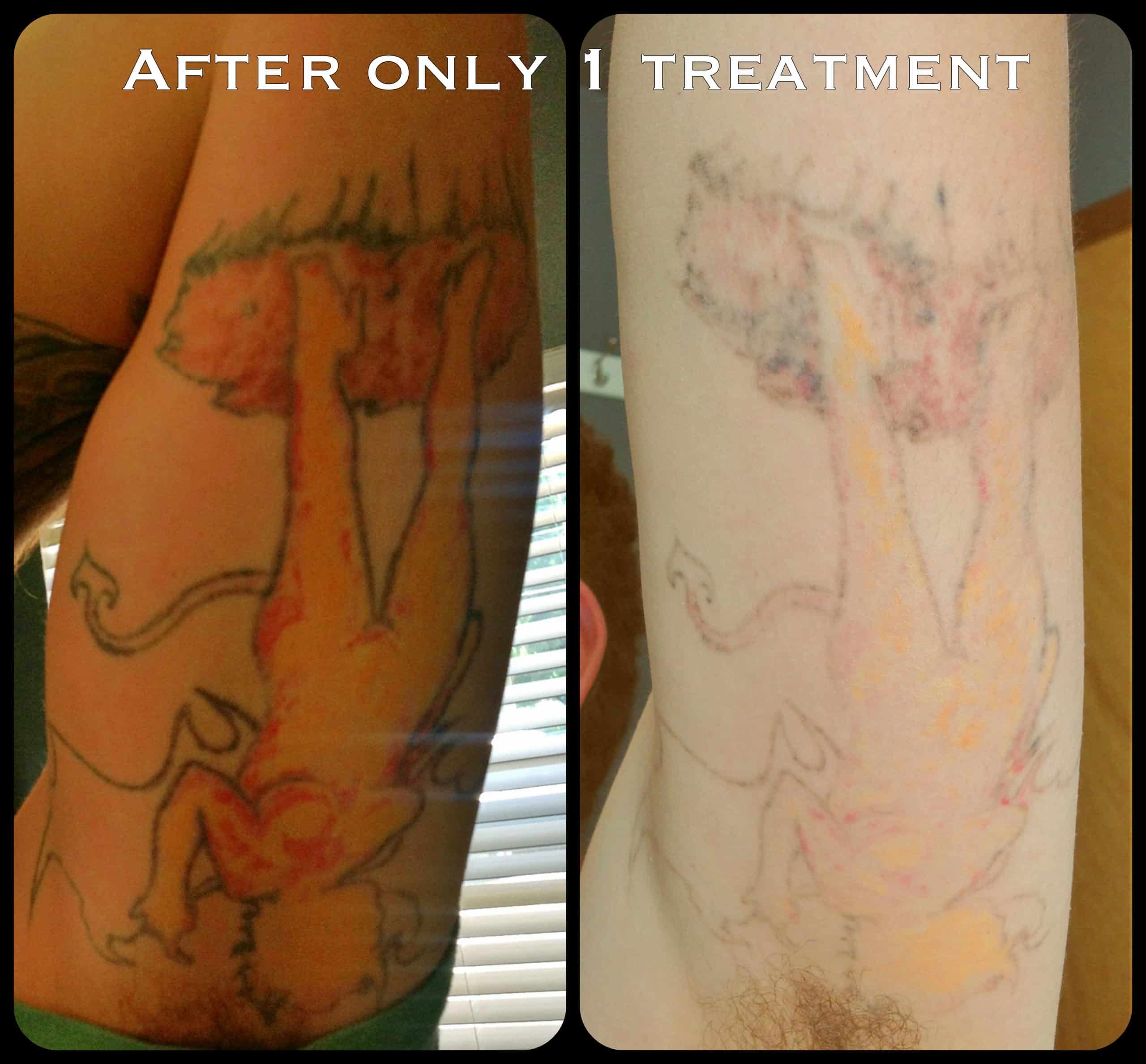 Laser Tattoo Removal Before and After 1 treatment â cascadelaserblog
