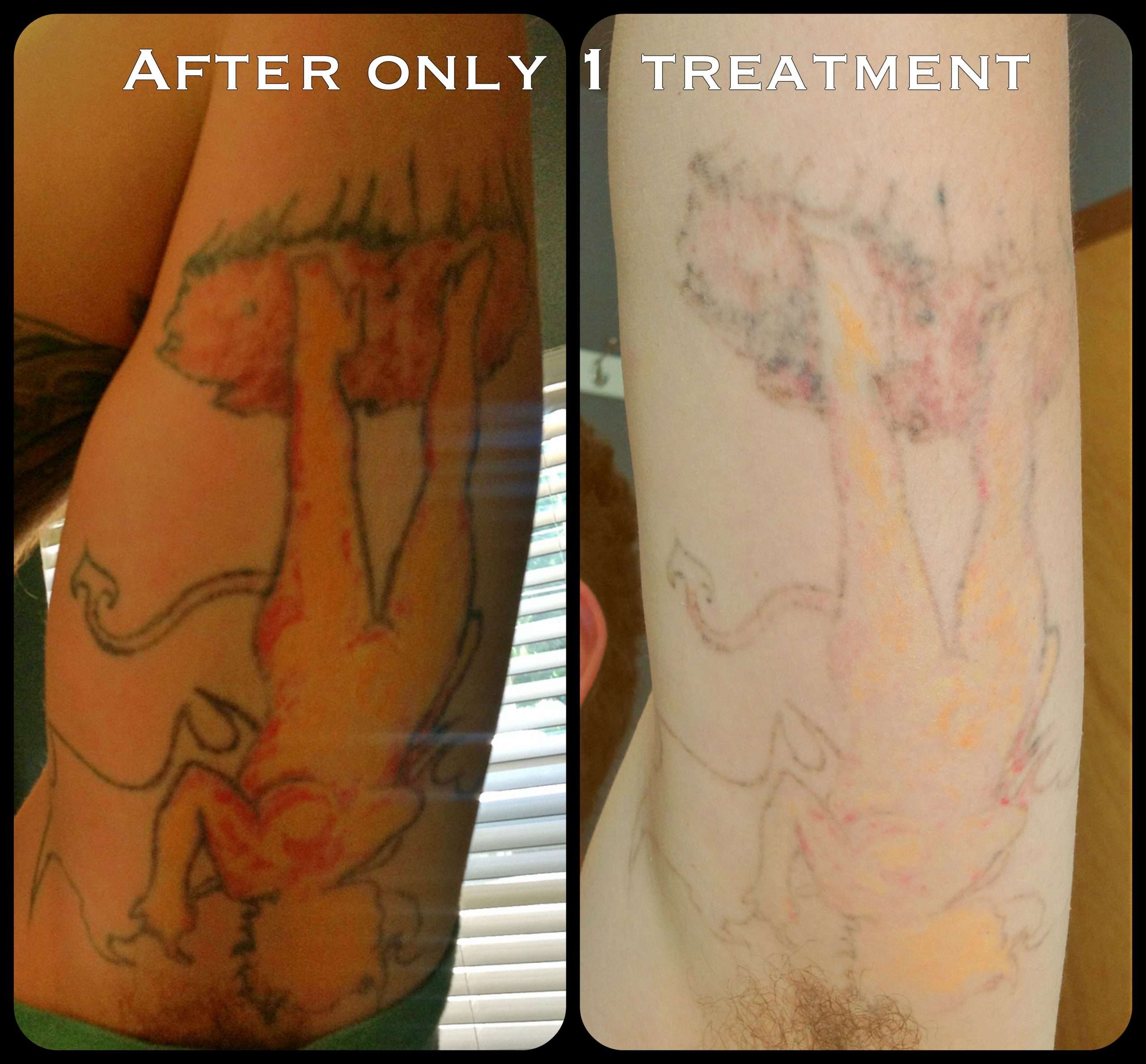 Laser Tattoo Removal Before and After 1 treatment ...